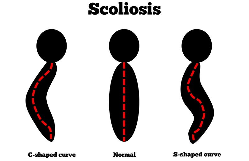 Coquitlam, BC scoliosis treatment